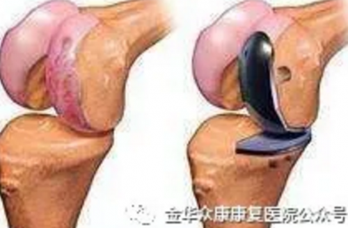 膝關(guān)節(jié)置換術(shù)適應(yīng)癥及何時(shí)進(jìn)行術(shù)后康復(fù)