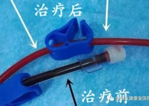 三氧自血療法可以治療什么疾??？